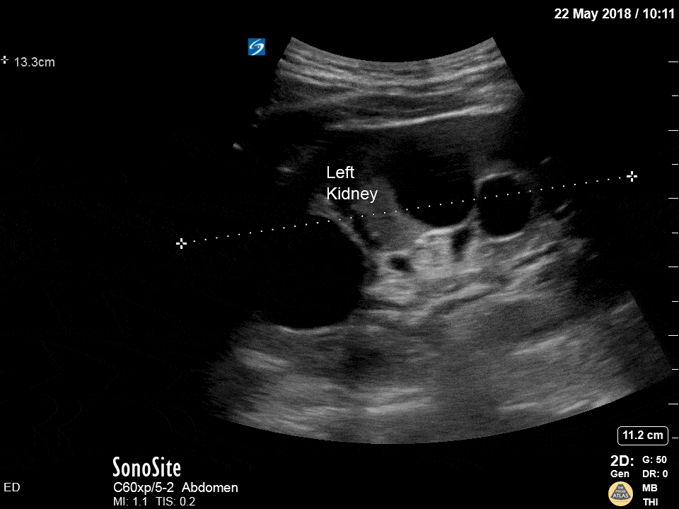 Renal/GU — TPA